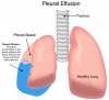 pleural-effusion.jpg