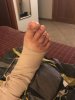 Broken foot.JPG