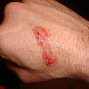 wound_1_