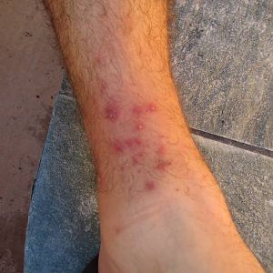 Ankle Herpes??